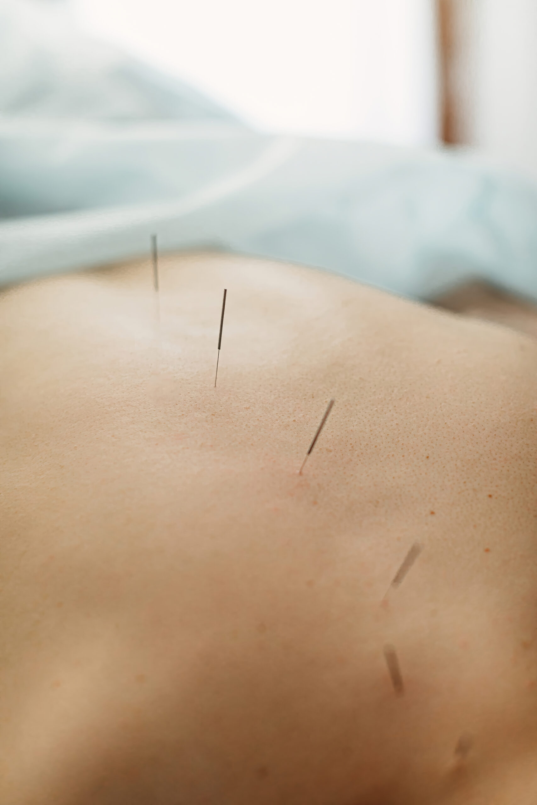 Woman with acupuncture needles in her back
